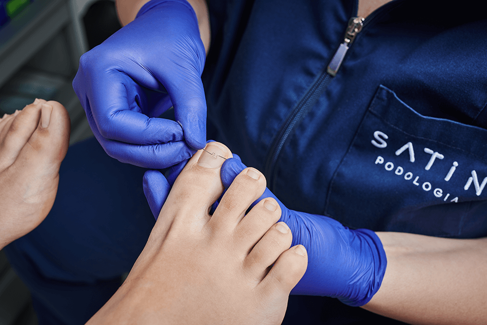 Klinika Satin – o leczeniu wrastających paznokci i wkręcających się paznokci opowiada podolog Hanna Suchecka