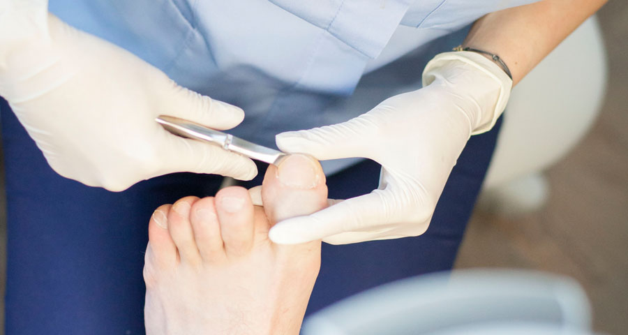 Różne metody leczenia wrastających paznokci – zabieg chirurgiczny nie jest jedynym rozwiązaniem